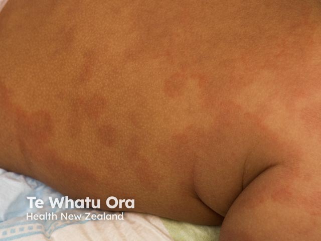 Acute urticarial rash in skin of colour