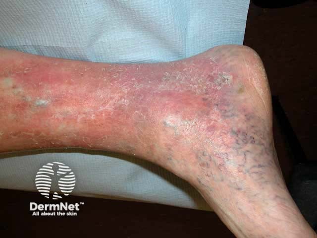 Corona phlebectatica and venous eczema