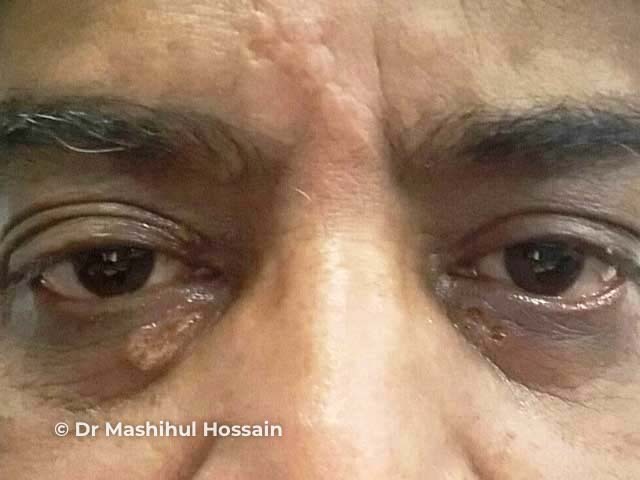 Xanthelasma: after laser ablation