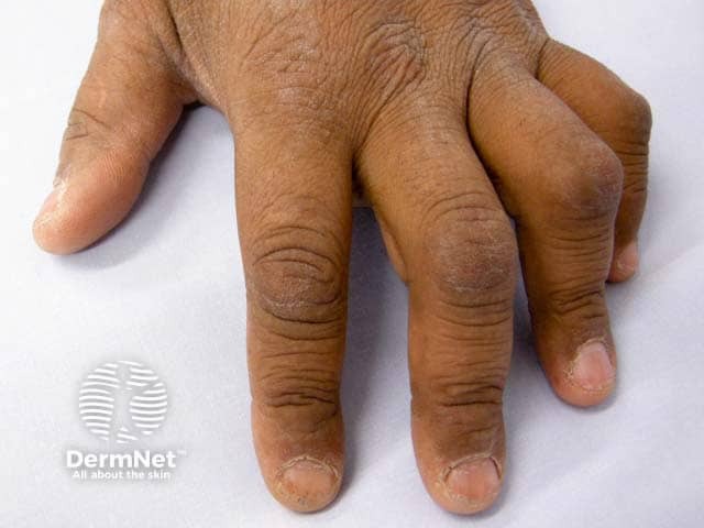 Velvet-like patches of acanthosis nigricans on the knuckles