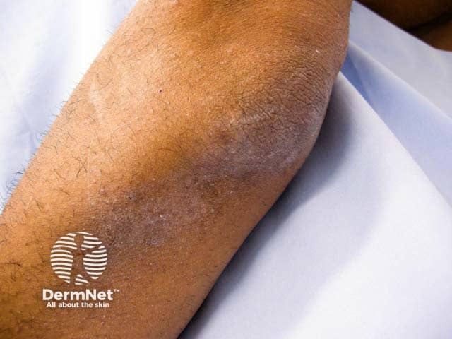 Acanthosis nigricans of the elbow