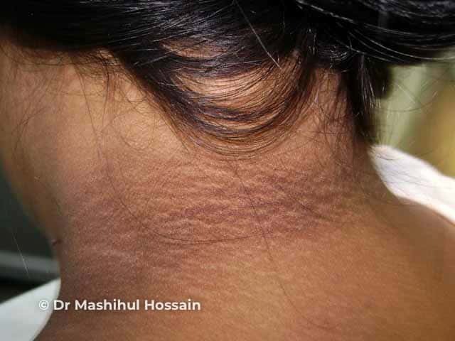 Acanthosis nigricans on the neck