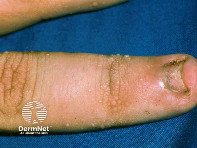 Acanthosis nigricans over the knuckles