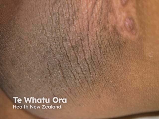 Upper inner arm acanthosis nigricans in obesity