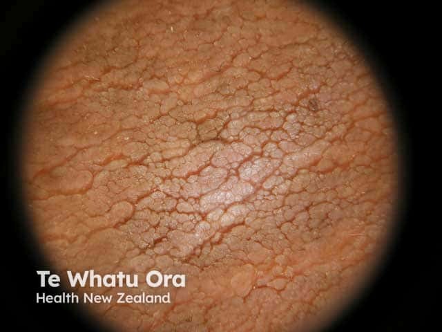 Acanthosis nigricans under dermoscopy