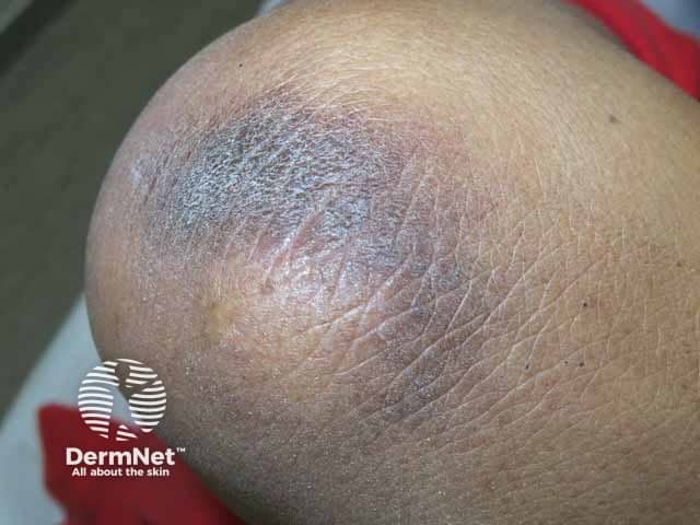 Elbow acanthosis nigricans