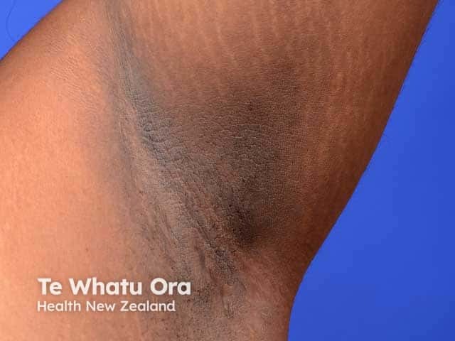 Axillary acanthosis nigricans