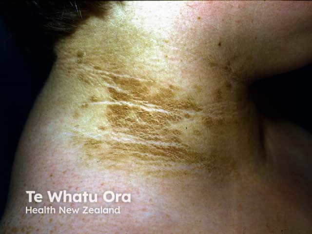 Acanthosis nigricans on the neck