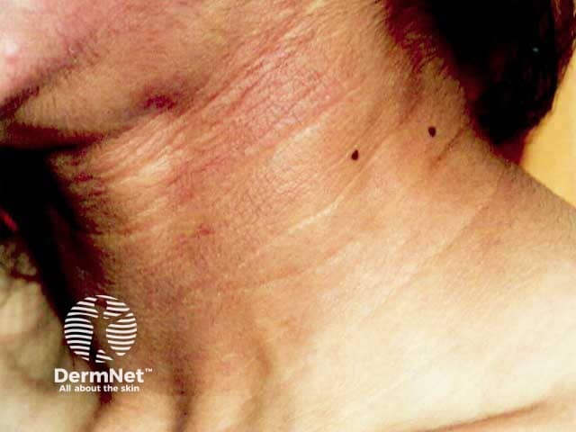 Acanthosis nigricans