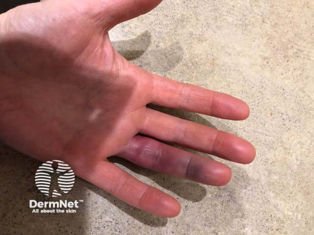 Painful fourth finger bruising after minor trauma from using a broom