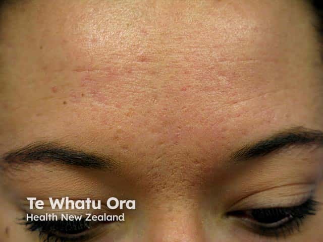 Fine post acne scarring over the glabella