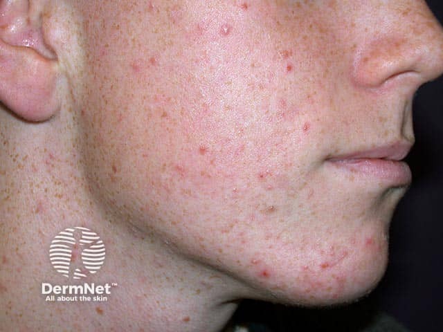 Mild papulopustular facial acne