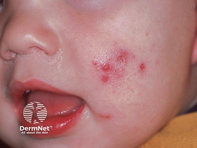 Papules and comedones in infantile acne on the cheeks