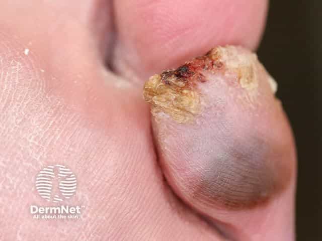 An irregular grey pigmented lesion on the toe that has become both hyperkeratotic and ulcerated on the toe tip