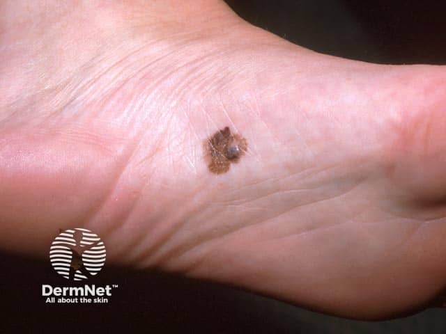 A nodule arrising within an acral lentiginous melanoma as it enters a vertical growth phase