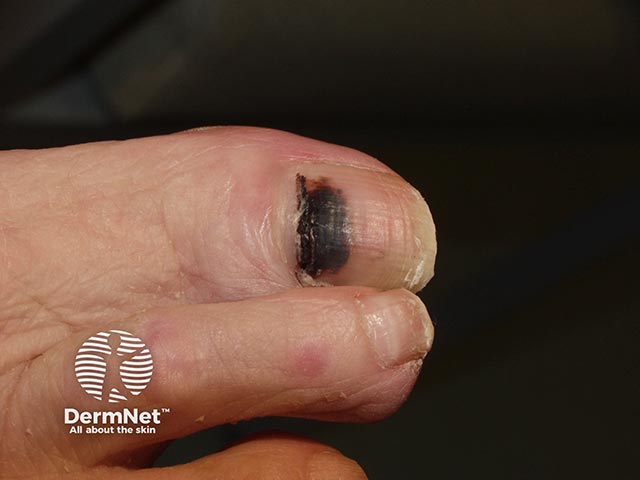 Brown-black irregularly-marginated pigment with extension into the cuticle - a subungual melanoma