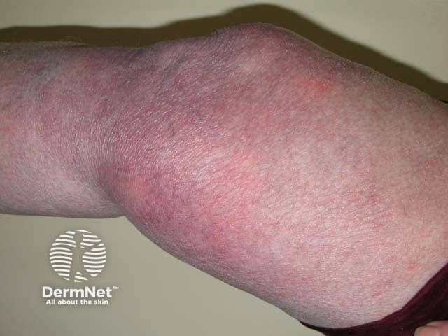 Inflammatory stage