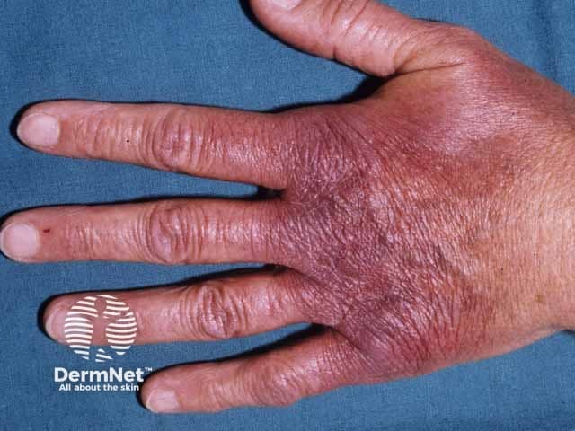 Inflammatory stage