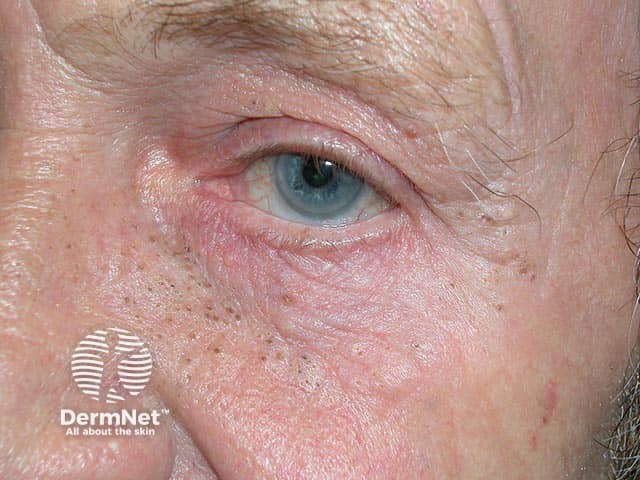 Solar elastosis and comedones on the upper cheek