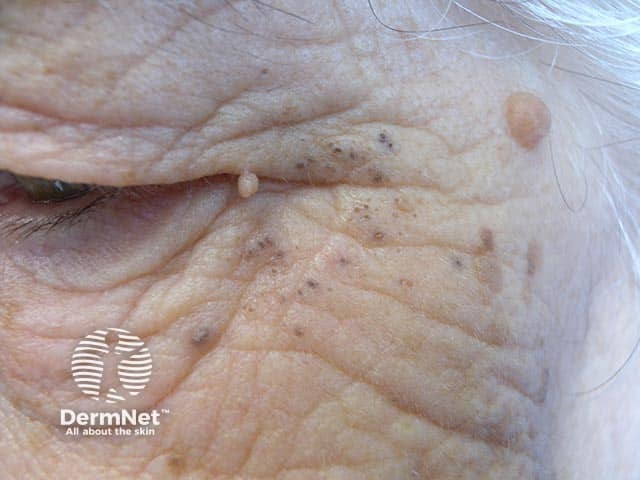 Coarse wrinkles and solar comedones on the upper cheek