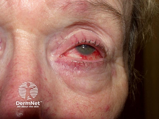 Episcleritis in acute febrile neutrophilic dermatosis