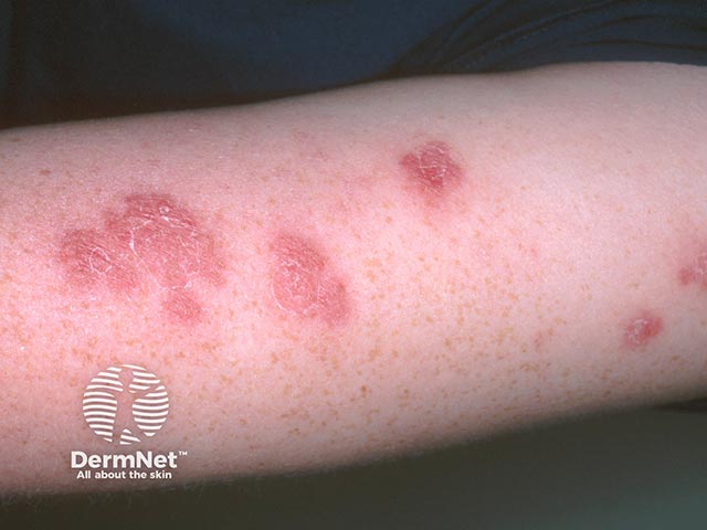 Annular plaques on the arm due to acute febrile neutrophilic dermatosis