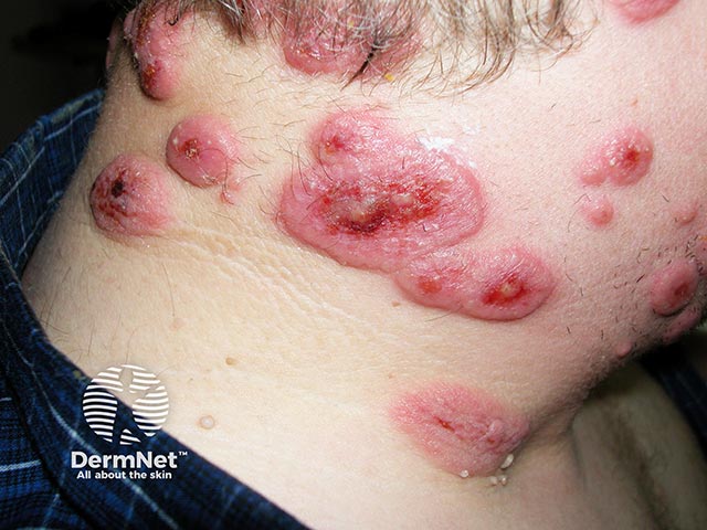 Tumid oedematous plaques due to acute febrile neutrophilic dermatosis