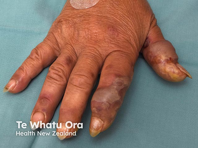 Oedematous lesions on the fingers due to acute febrile neutrophilic dermatosis of the dorsal hands