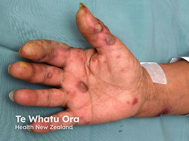 Acute febrile neutrophilic dermatosis of the dorsal hands - has also spread round onto the palm