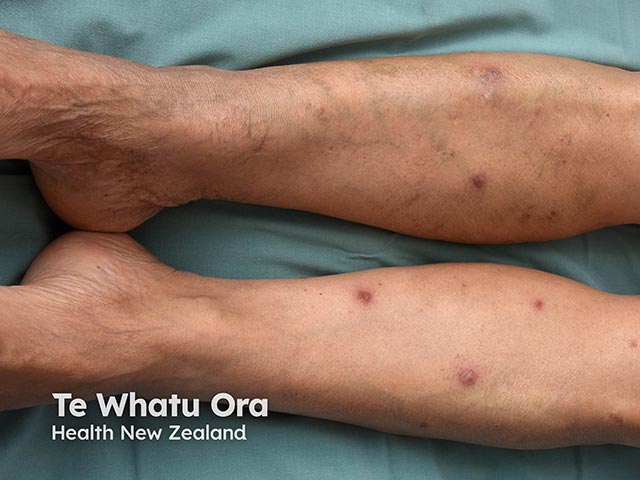 Lesions of acute febrile neutrophilic dermatosis on the legs