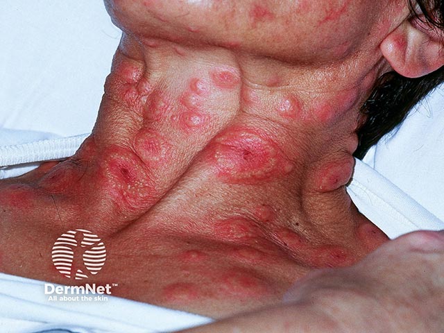 Annular lesions of acute febrile neutrophilic dermatosis on the neck - note the peripheral pseudo-vesiculation