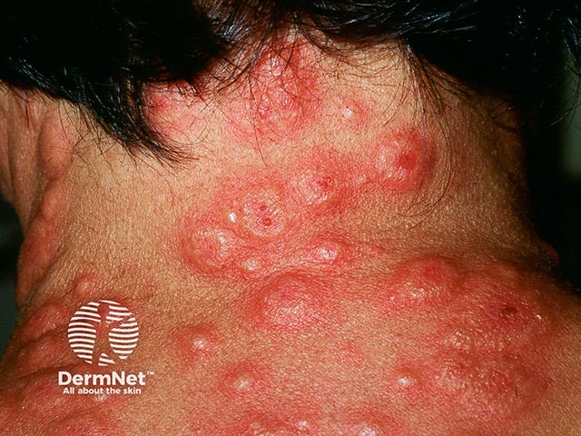 Acute febrile neutrophilic dermatosis on the neck