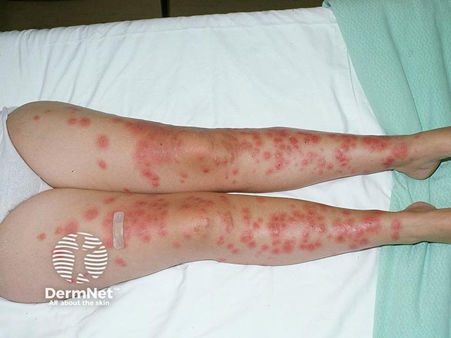 Extensive acute febrile neutrophilic dermatosis on the legs