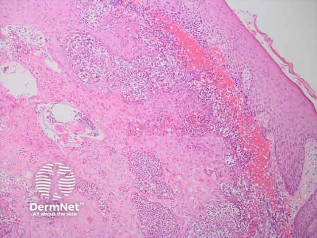 Upper dermal neutrophilic infilltrate in cutaneous myeloid sarcoma H and E histopathology