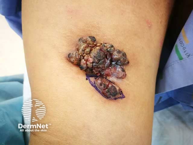 Warty cutaneous myeloid sarcoma on thigh