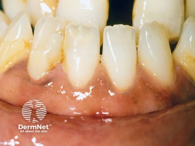 Gingival pigmentation was the clue to underlying Addison disease, presenting as an Addisonian crisis