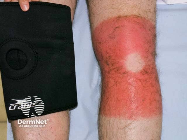 Allergic contact dermatitis: rubber accelerator in knee support