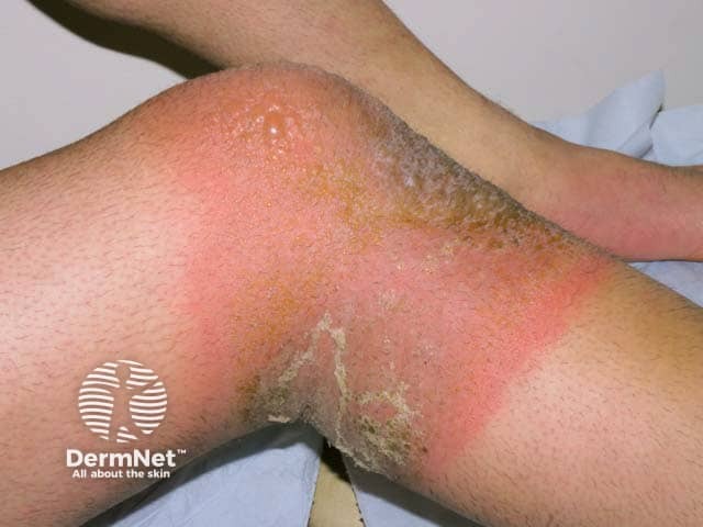 Acute allergic contact dermatitis: rubber accelerator in knee support