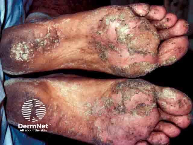 Pigmented allergic contact dermatitis due to chromate in a sandal sole