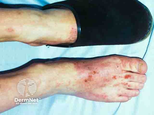 Allergic contact dermatitis due to a component of the shoe upper 