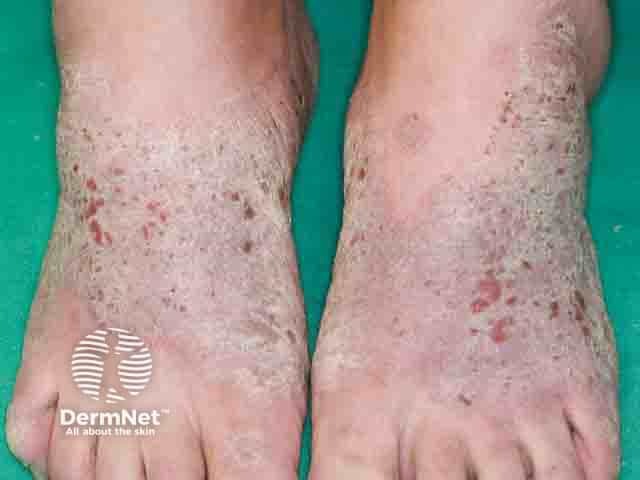 Allergic contact dermatitis due to a shoe upper component