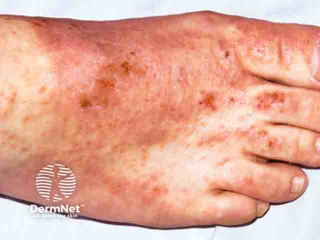 Chromate allergy causing contact dermatitis from a leather shoe upper