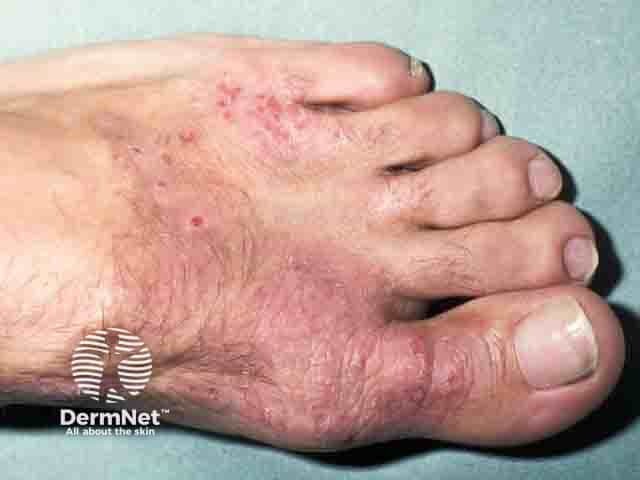 Contact allergy to a shoe upper constituent