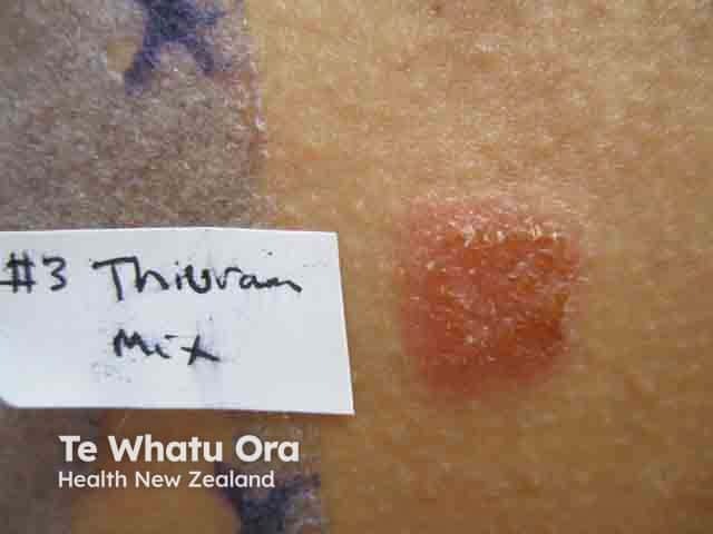 A strong positive reaction to thiuram mix in a woman with shoe dermatitis