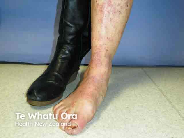 Allergic contact dermatitis due to a leather boot - chromate allergy was confimed on patch testing