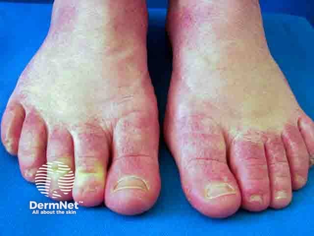 Allergic contact dermatitis over the forefoot