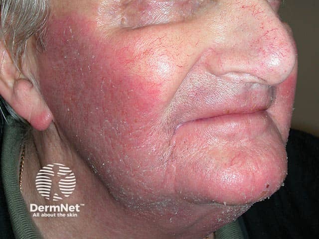 Facial allergic contact dermatitis due to perfume in an aftershave