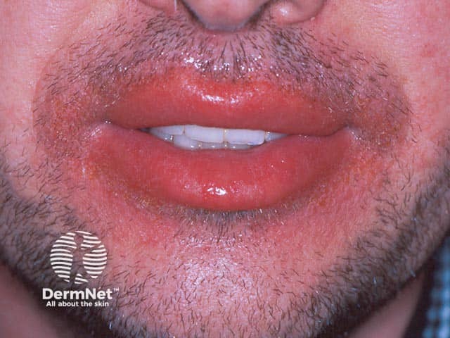 Allergic contact dermatitis due to propyl gallate in a lip salve