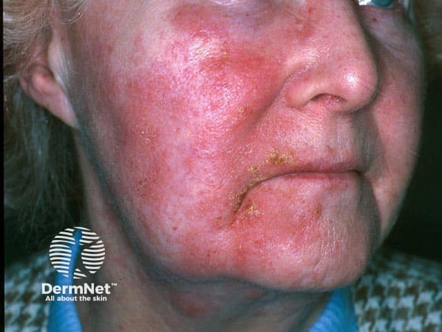 Allergic contact dermatitis due to lavender oil that was applied to her pillow to help her sleep