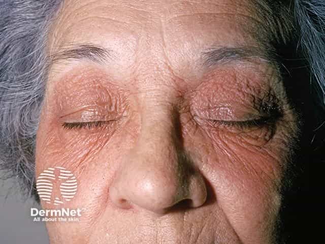 Periocular eczema due to allergic contact dermatitis to an eye drop constituent